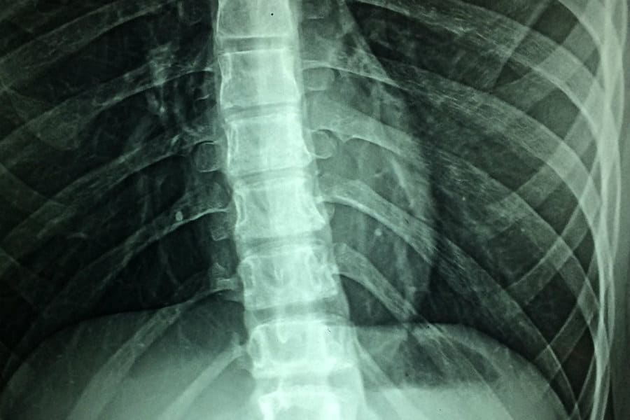 Spinal Cord Stimulator Implantation - Featured Image