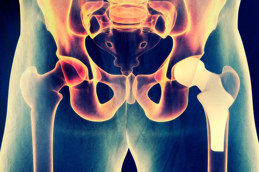 arthritis in the hips