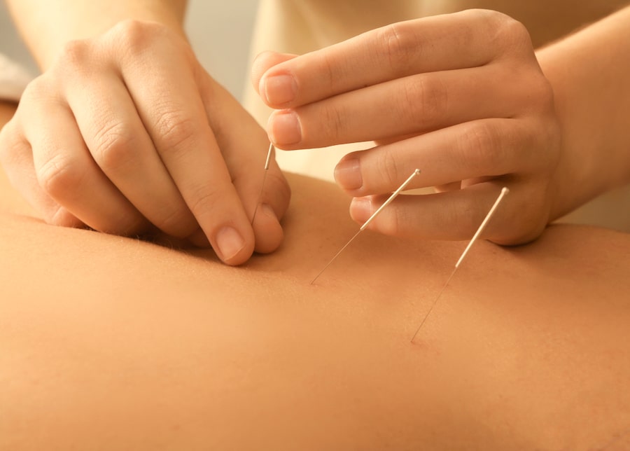 Acupuncture for Pain Management