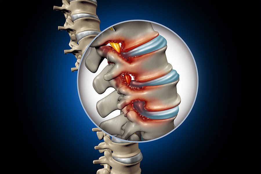 Stem Cell Therapy for Spinal Stenosis - Featured Image