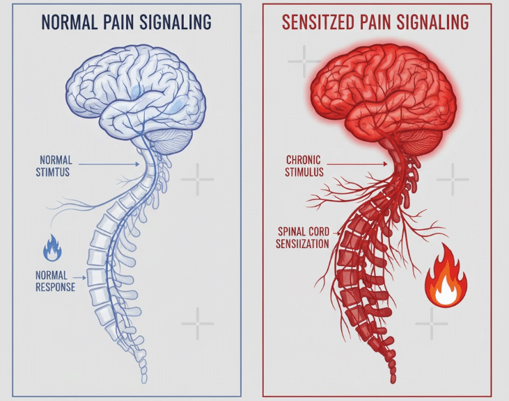 Medical illustration of nervous system pain signal amplification