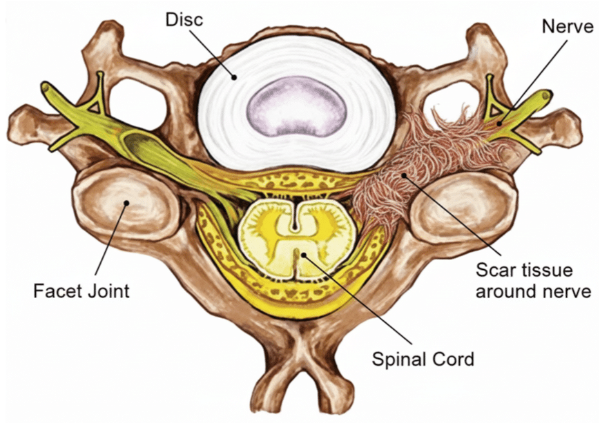 Medical illustration of epidural fibrosis after spine surgery